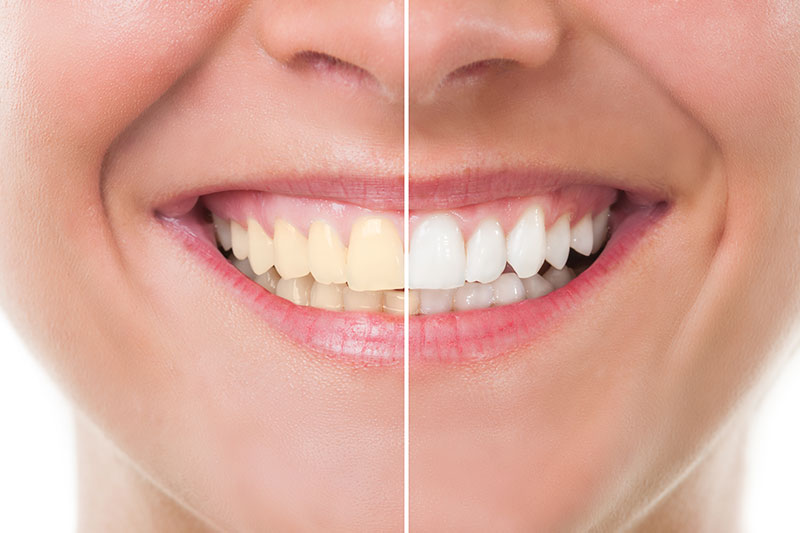 Teeth Whitening in Dallas